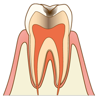 【C1】エナメル質のむし歯
