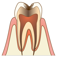 【C2】象牙質のむし歯