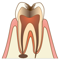【C3】神経まで達するむし歯
