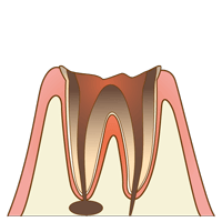 【C4】歯がなくなるまで進行したむし歯