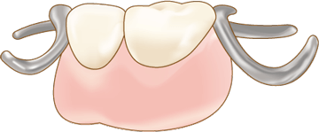 部分入れ歯