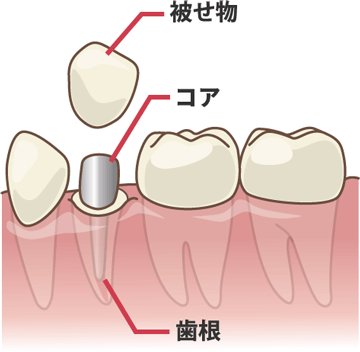 差し歯